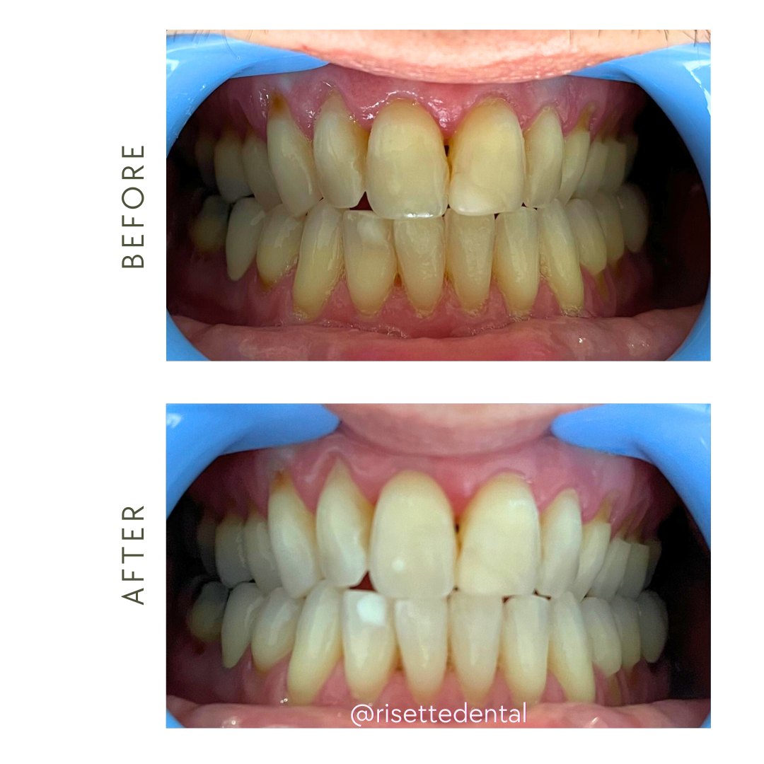 teeth whitening before and after teeth whitening Langley Laser teeth whitening Langley