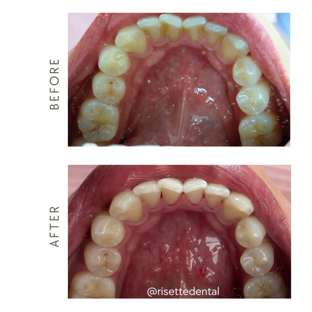 Dental Cleaning + Whitening