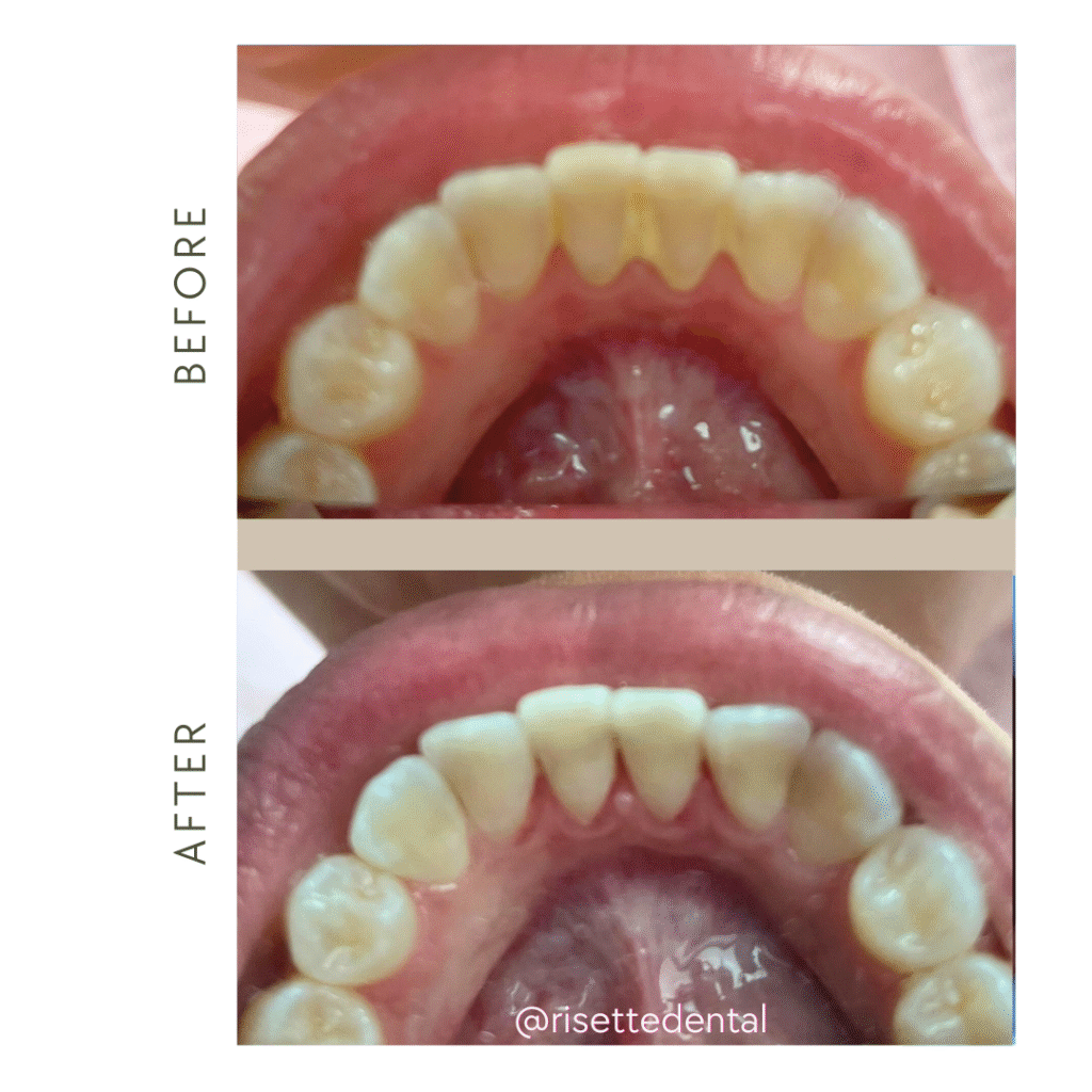 Routine Dental Cleaning